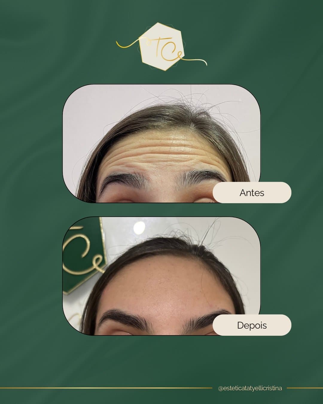 Botox na Estética Tatyelli Cristina
