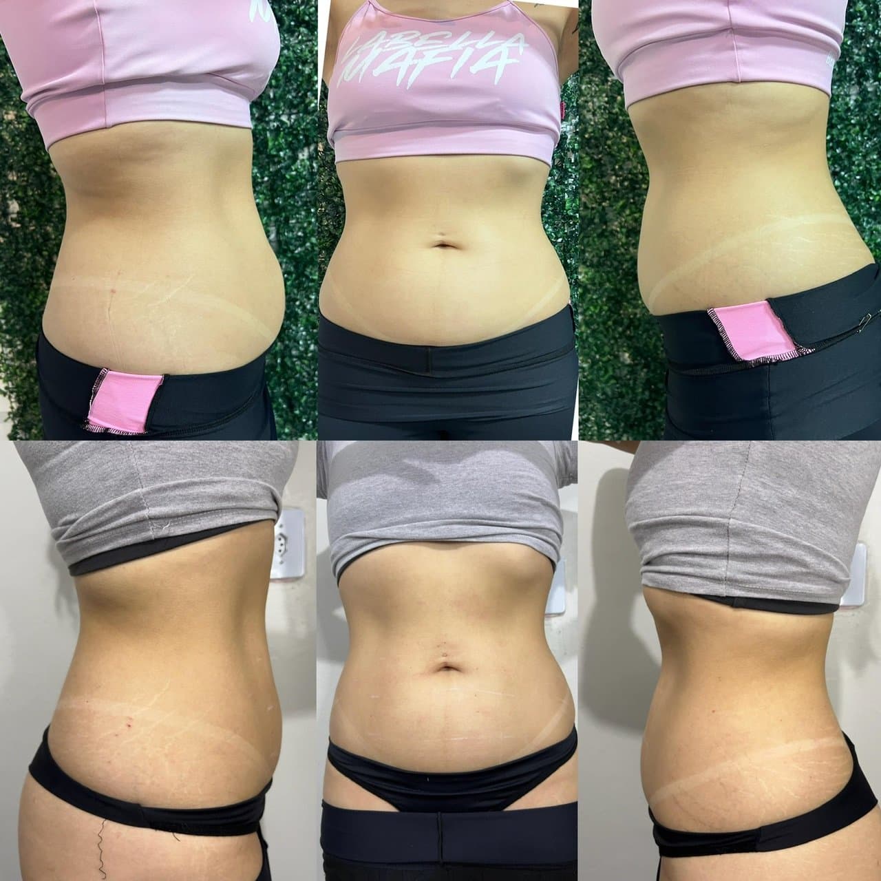 Criofrequência na Estética Tatyelli Cristina