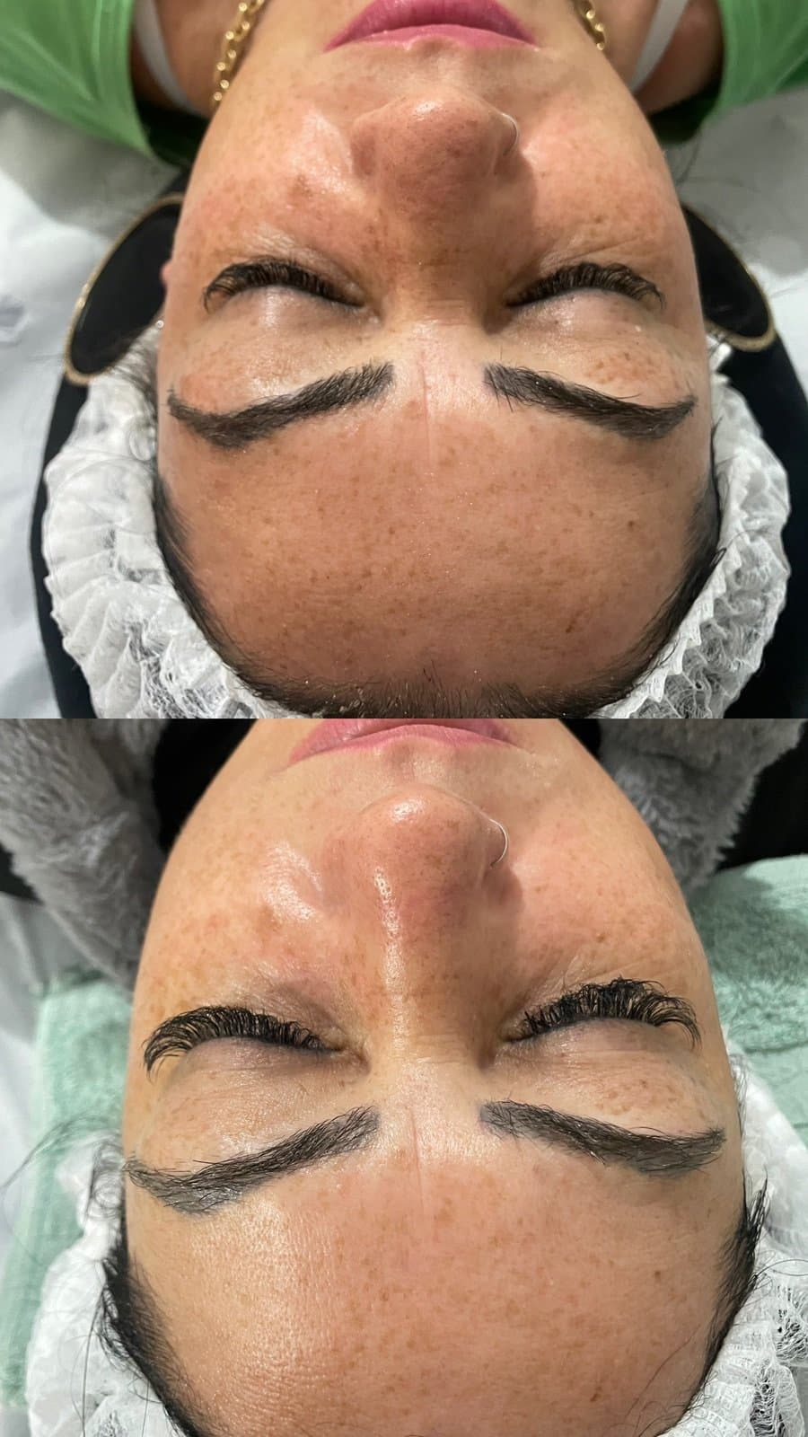 Peeling Químico na Estética Tatyelli Cristina