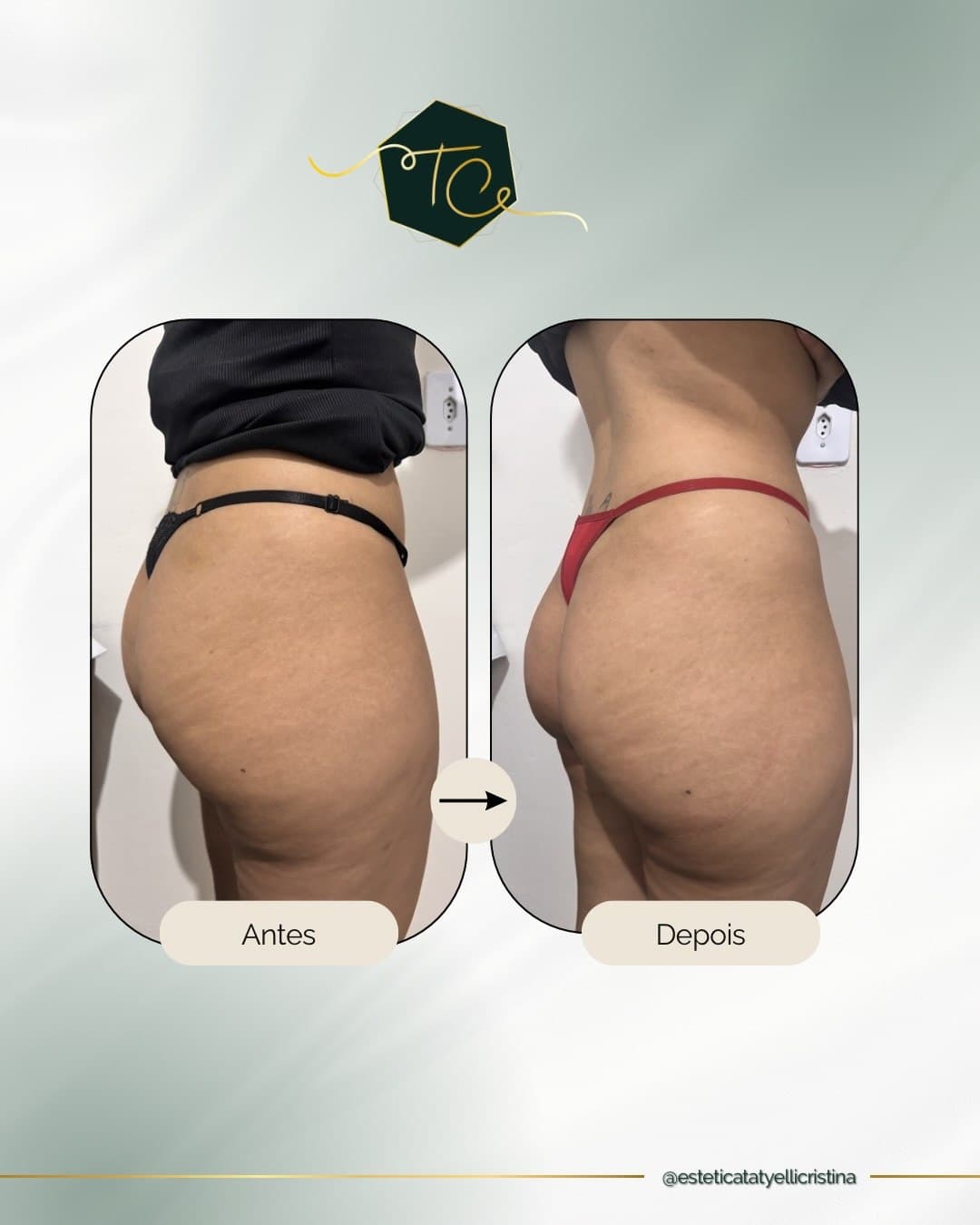 Antes e depois autorizado de protocolo corporal na Estética Tatyelli Cristina