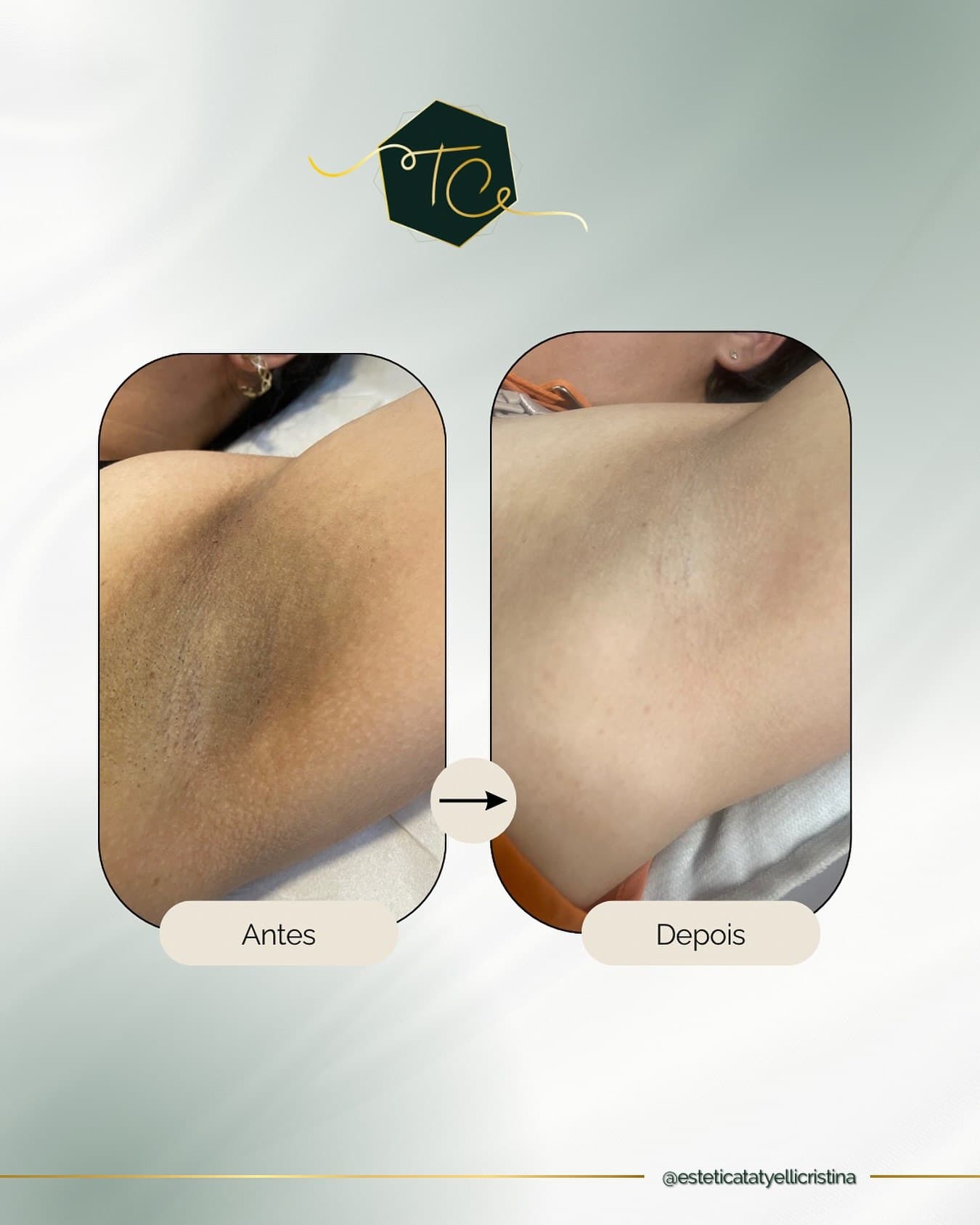 Antes e depois autorizado de depilação a laser na Estética Tatyelli Cristina